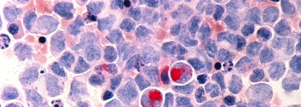 Leucemia